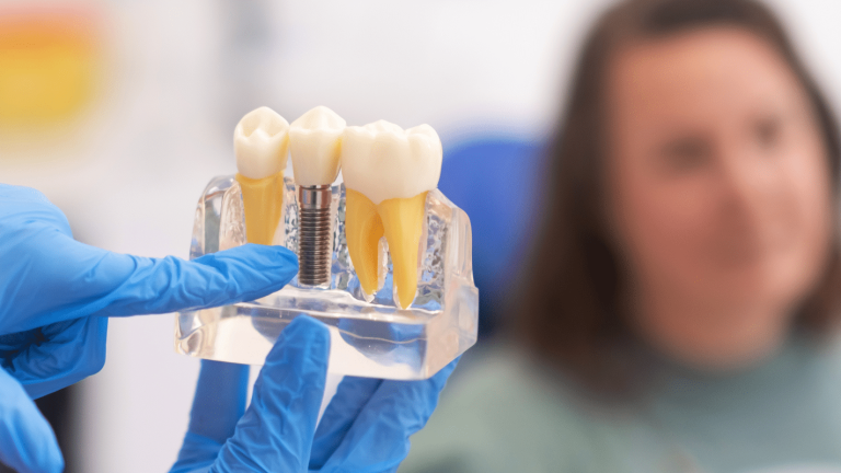 Essential Dental Implants Tips For A Stunning Smile